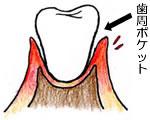 第2段階 軽度歯周炎のイラスト