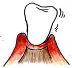 第4段階 重度歯周病